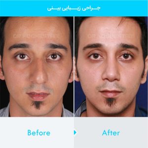 rhinoplasty-302