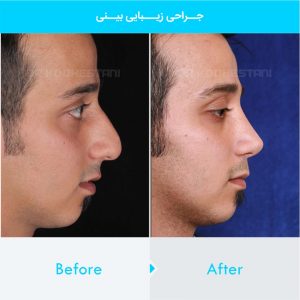 rhinoplasty-303