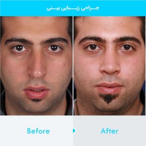 rhinoplasty-304