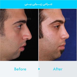 rhinoplasty-305