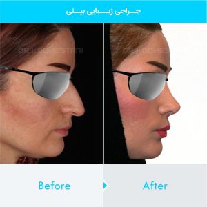 rhinoplasty-307