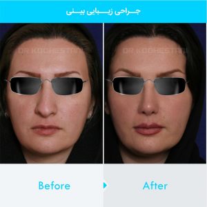 rhinoplasty-309