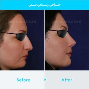 rhinoplasty-310