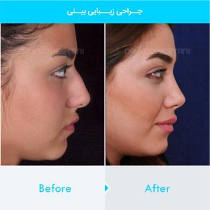 rhinoplasty-312