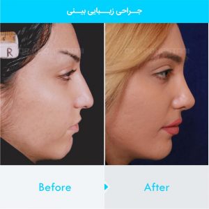 rhinoplasty-314