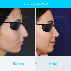 rhinoplasty-317