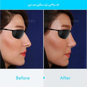 rhinoplasty-319