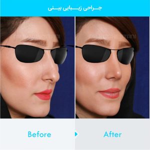 rhinoplasty-320