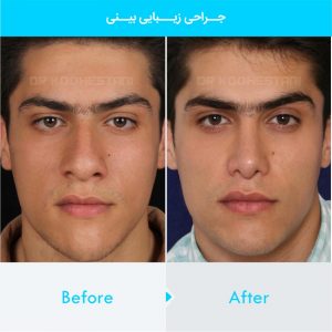 rhinoplasty-321