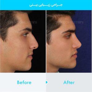 rhinoplasty-322