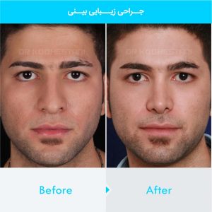 rhinoplasty-323