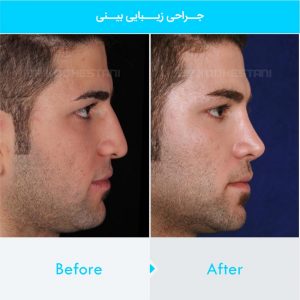 rhinoplasty-324