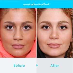 rhinoplasty-325