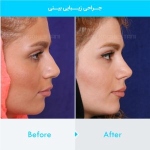 rhinoplasty-326