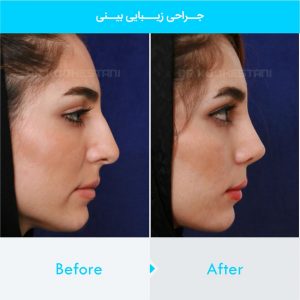 rhinoplasty-328