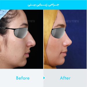 rhinoplasty-330