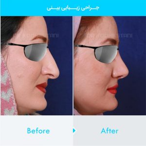 rhinoplasty-333