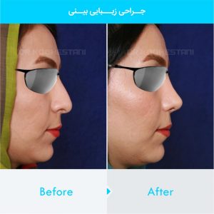 rhinoplasty-336