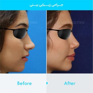 rhinoplasty-339