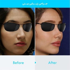 rhinoplasty-340