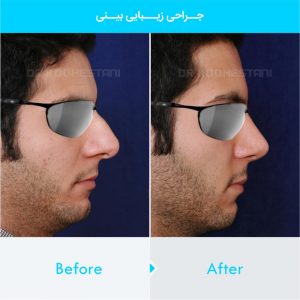 rhinoplasty-342