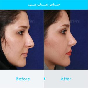 rhinoplasty-345