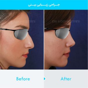 rhinoplasty-348