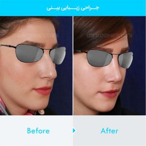 rhinoplasty-349