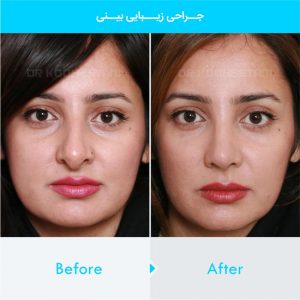 rhinoplasty-350