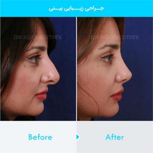 rhinoplasty-351