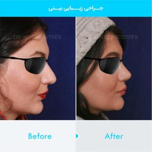 rhinoplasty-354