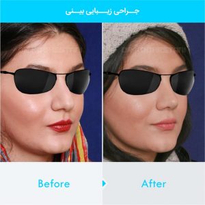 rhinoplasty-355
