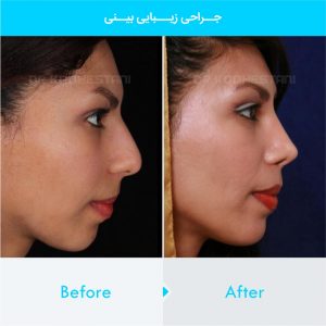 rhinoplasty-357