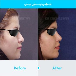 rhinoplasty-360