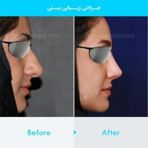 rhinoplasty-363