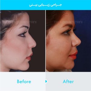 rhinoplasty-365