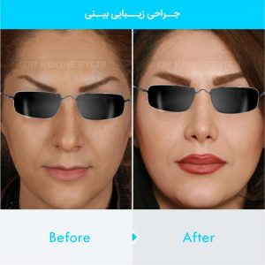 rhinoplasty-367