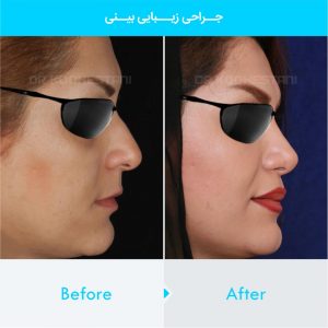 rhinoplasty-368