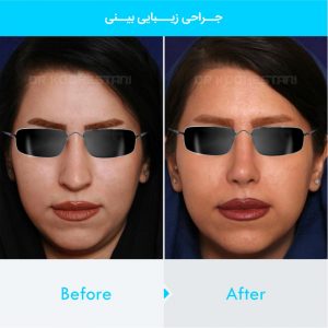 rhinoplasty-369