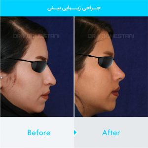 rhinoplasty-370