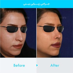 rhinoplasty-371