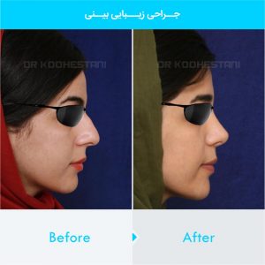 rhinoplasty-373