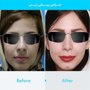 rhinoplasty-375