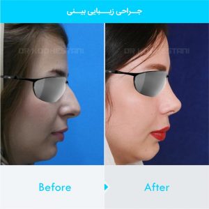 rhinoplasty-376