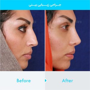 rhinoplasty-379