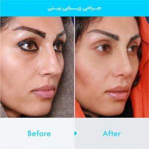 rhinoplasty-380