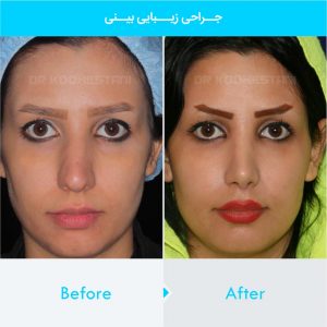 rhinoplasty-381