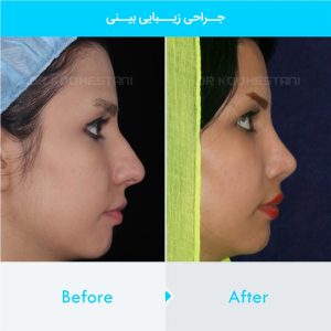 rhinoplasty-382