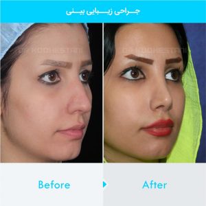 rhinoplasty-383