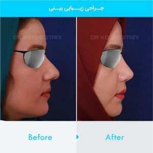 rhinoplasty-385